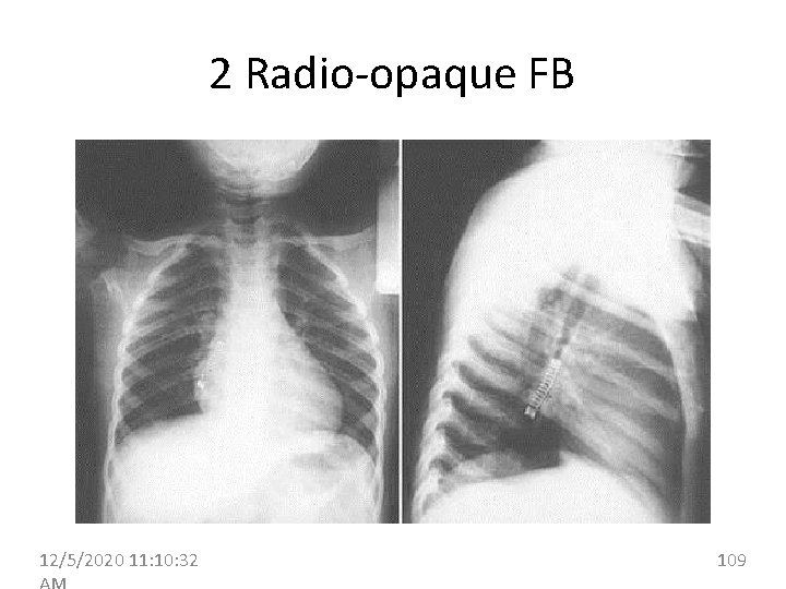 2 Radio-opaque FB 12/5/2020 11: 10: 32 109 
