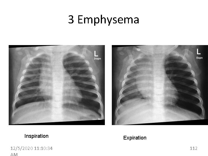 3 Emphysema Inspiration 12/5/2020 11: 10: 34 Expiration 112 