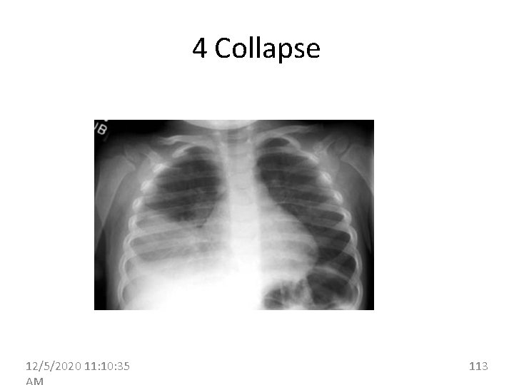 4 Collapse 12/5/2020 11: 10: 35 113 