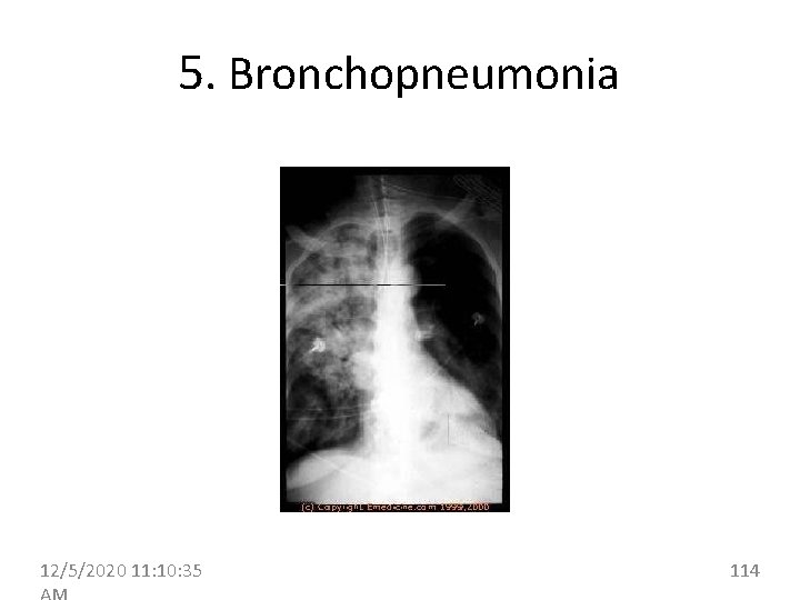 5. Bronchopneumonia 12/5/2020 11: 10: 35 114 