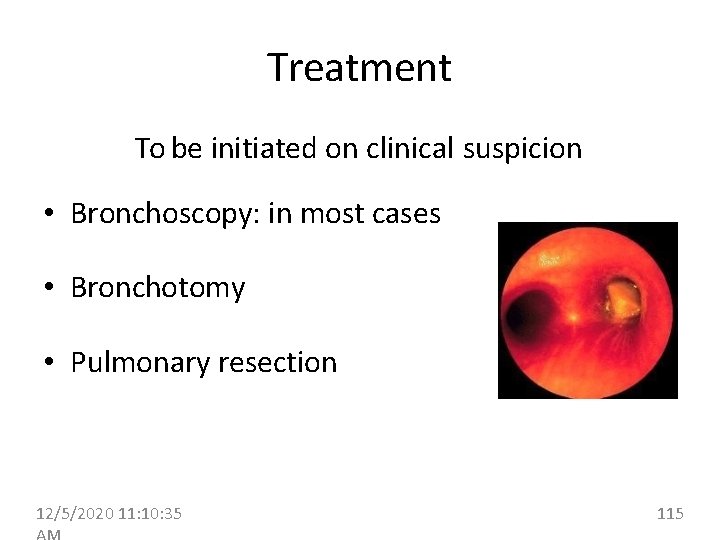 Treatment To be initiated on clinical suspicion • Bronchoscopy: in most cases • Bronchotomy