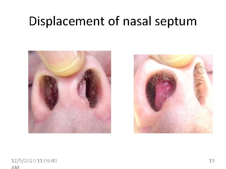 Displacement of nasal septum 12/5/2020 11: 09: 43 15 