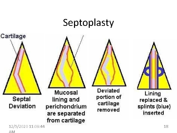 Septoplasty 12/5/2020 11: 09: 44 18 