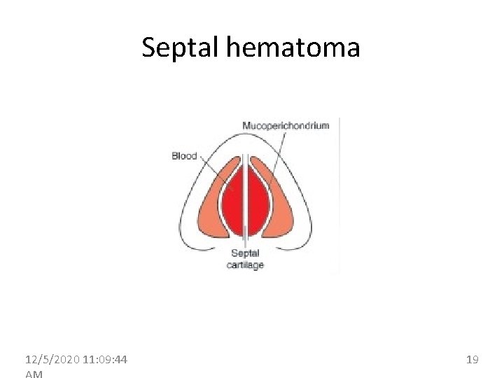 Septal hematoma 12/5/2020 11: 09: 44 19 