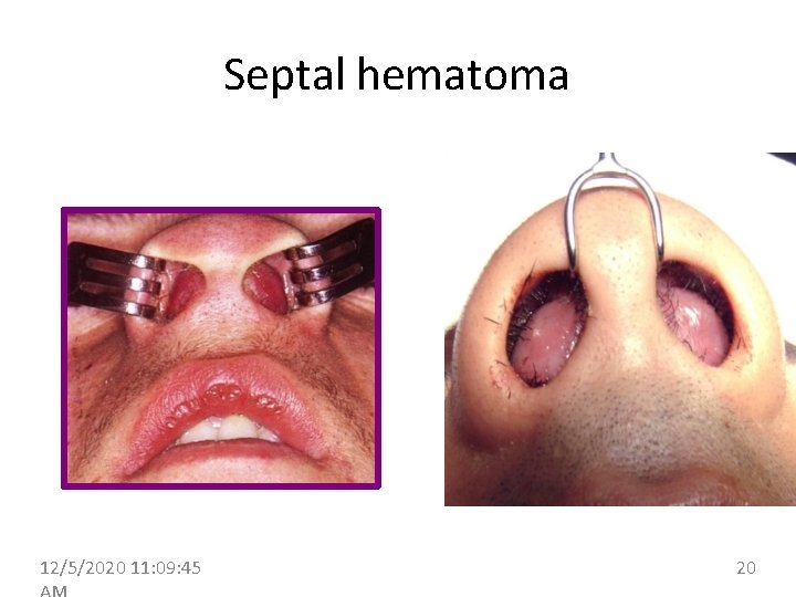 Septal hematoma 12/5/2020 11: 09: 45 20 