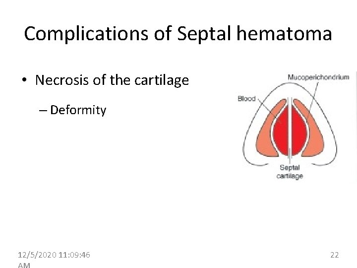 Complications of Septal hematoma • Necrosis of the cartilage – Deformity 12/5/2020 11: 09: