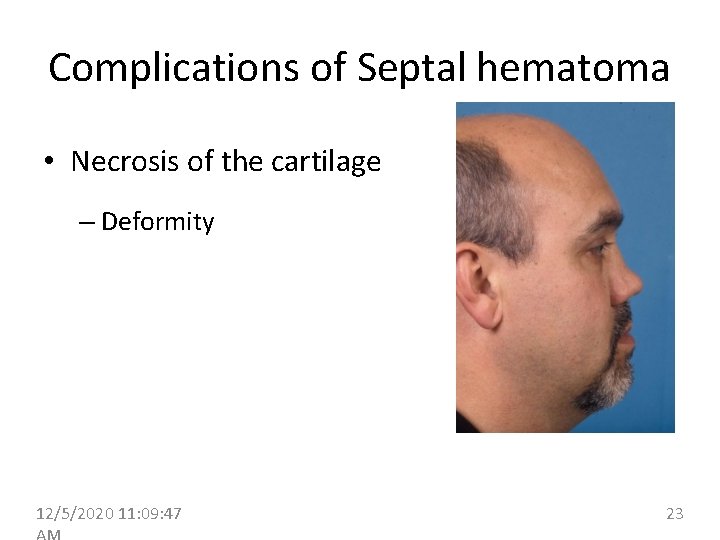 Complications of Septal hematoma • Necrosis of the cartilage – Deformity 12/5/2020 11: 09: