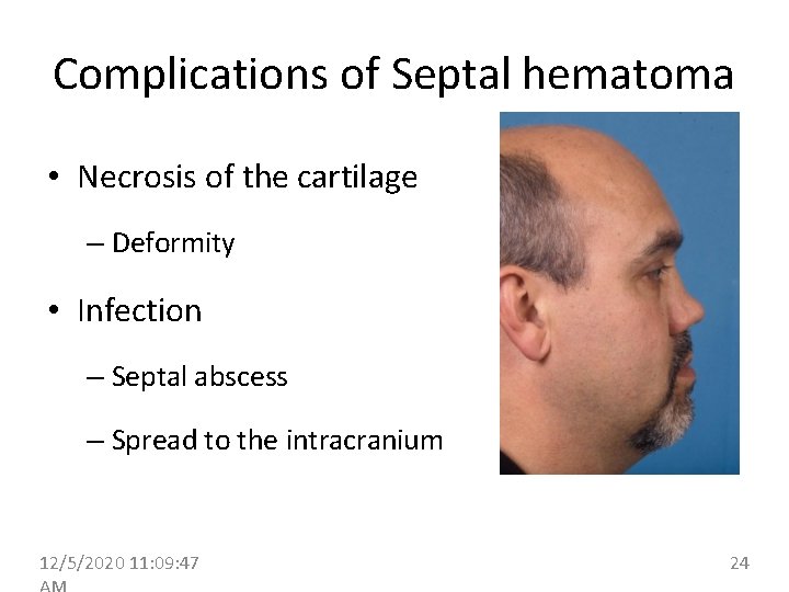 Complications of Septal hematoma • Necrosis of the cartilage – Deformity • Infection –