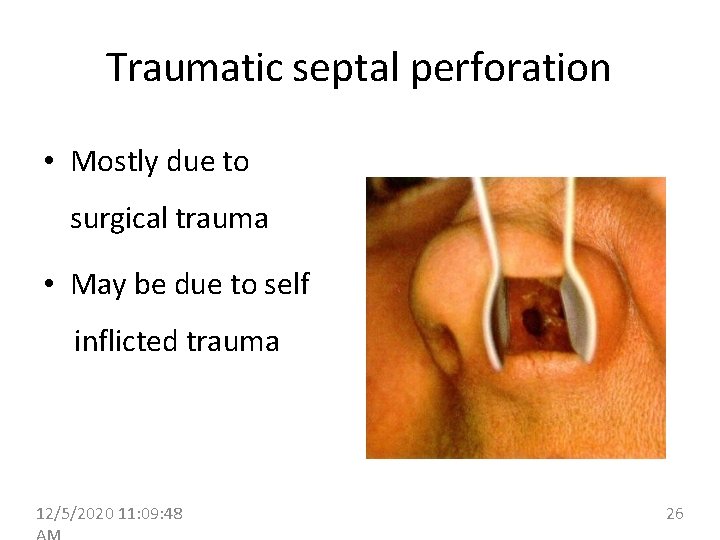 Traumatic septal perforation • Mostly due to surgical trauma • May be due to