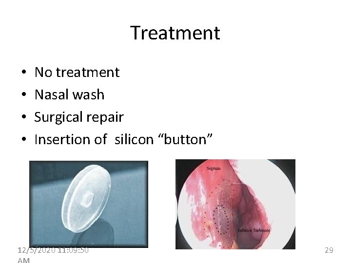 Treatment • • No treatment Nasal wash Surgical repair Insertion of silicon “button” 12/5/2020
