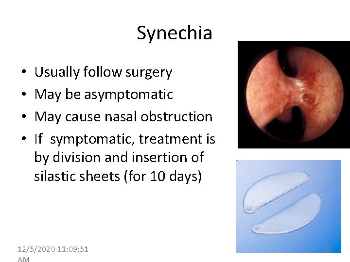 Synechia • • Usually follow surgery May be asymptomatic May cause nasal obstruction If