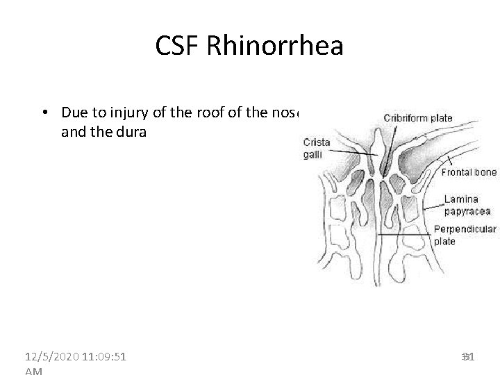 CSF Rhinorrhea • Due to injury of the roof of the nos e and