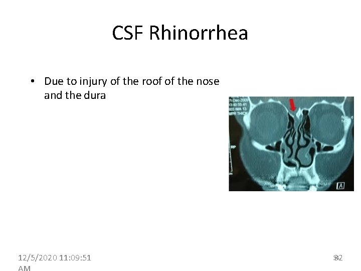 CSF Rhinorrhea • Due to injury of the roof of the nose and the