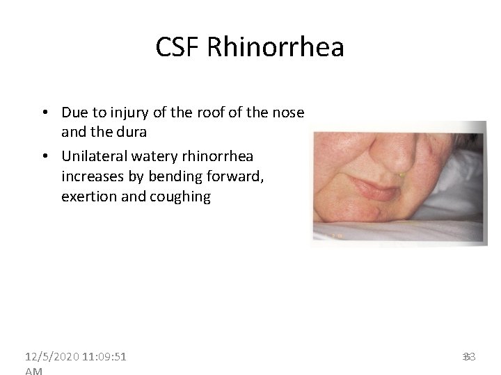 CSF Rhinorrhea • Due to injury of the roof of the nose and the