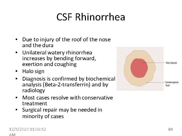 CSF Rhinorrhea • Due to injury of the roof of the nose and the