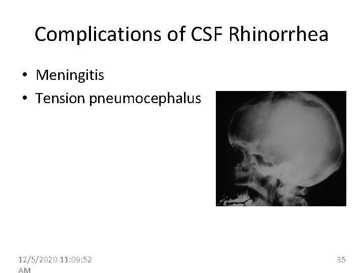 Complications of CSF Rhinorrhea • Meningitis • Tension pneumocephalus 12/5/2020 11: 09: 52 35