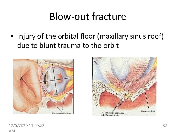 Blow-out fracture • Injury of the orbital floor (maxillary sinus roof) due to blunt