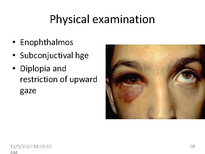 Physical examination • Enophthalmos • Subconjuctival hge • Diplopia and restriction of upward gaze