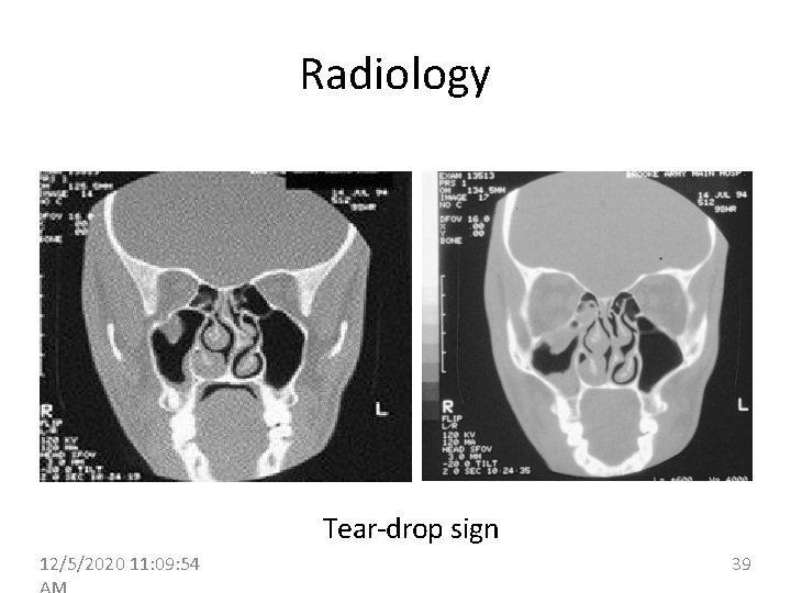 Radiology Tear-drop sign 12/5/2020 11: 09: 54 39 