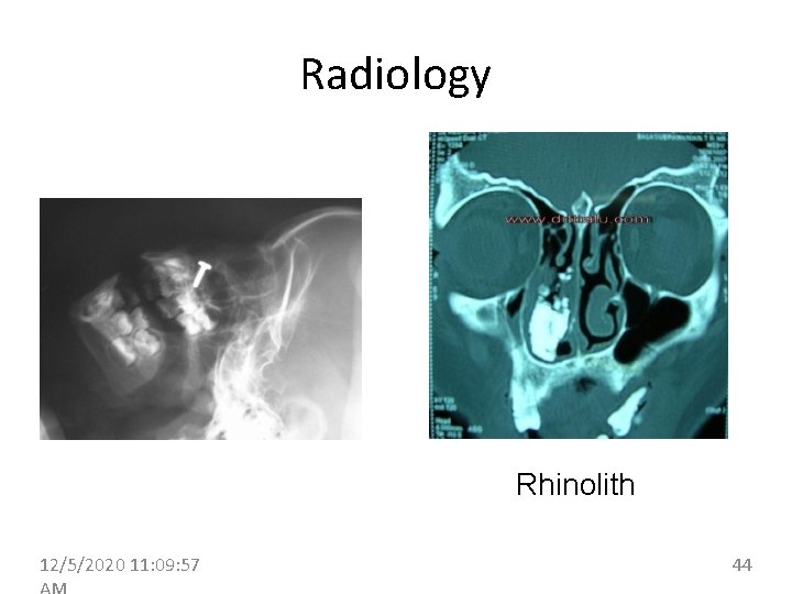 Radiology Rhinolith 12/5/2020 11: 09: 57 44 