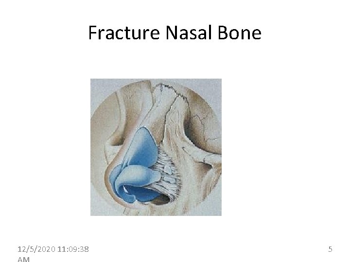 Fracture Nasal Bone 12/5/2020 11: 09: 38 5 