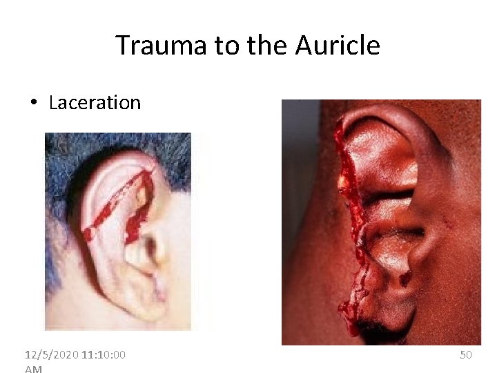 Trauma to the Auricle • Laceration 12/5/2020 11: 10: 00 50 