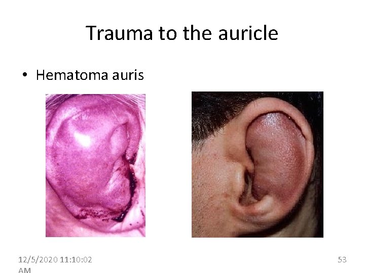 Trauma to the auricle • Hematoma auris 12/5/2020 11: 10: 02 53 