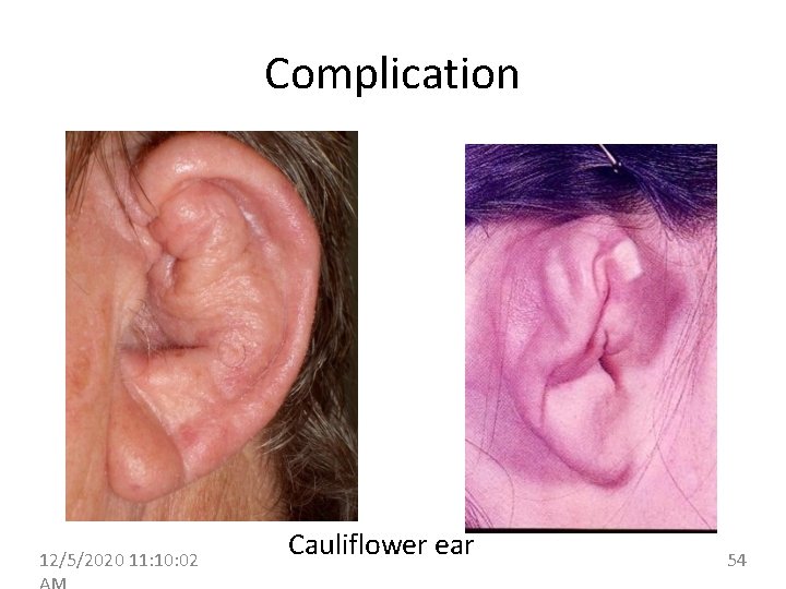 Complication 12/5/2020 11: 10: 02 Cauliflower ear 54 