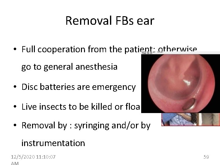 Removal FBs ear • Full cooperation from the patient; otherwise go to general anesthesia
