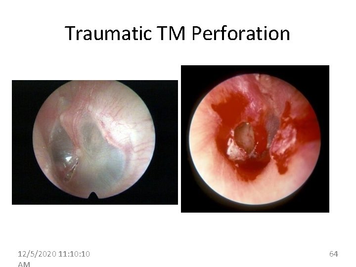 Traumatic TM Perforation 12/5/2020 11: 10 64 