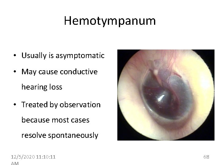 Hemotympanum • Usually is asymptomatic • May cause conductive hearing loss • Treated by