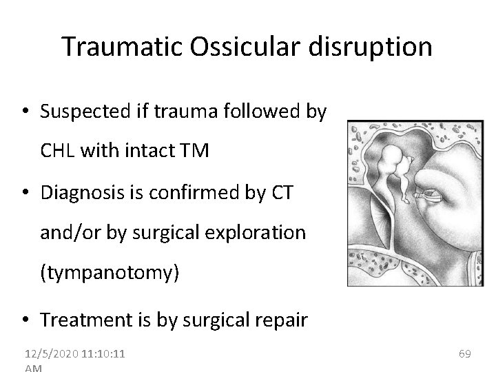Traumatic Ossicular disruption • Suspected if trauma followed by CHL with intact TM •