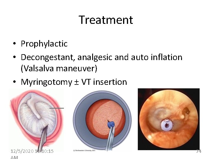 Treatment • Prophylactic • Decongestant, analgesic and auto inflation (Valsalva maneuver) • Myringotomy ±