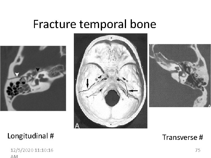 Fracture temporal bone Longitudinal # 12/5/2020 11: 10: 16 Transverse # 75 