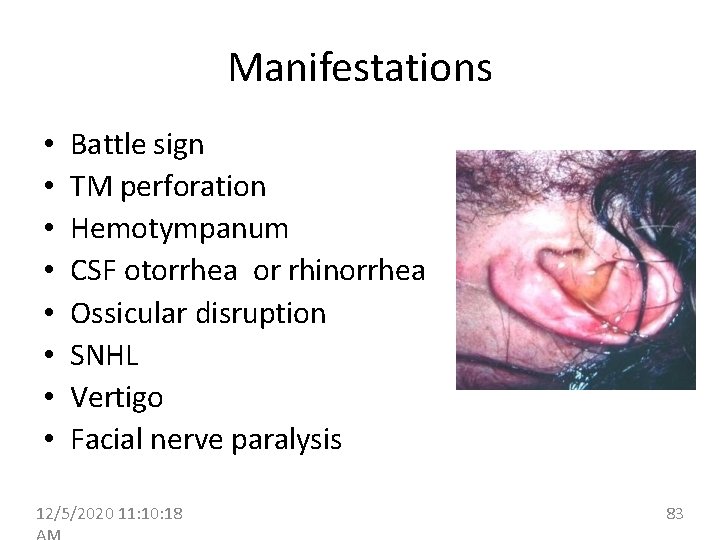 Manifestations • • Battle sign TM perforation Hemotympanum CSF otorrhea or rhinorrhea Ossicular disruption