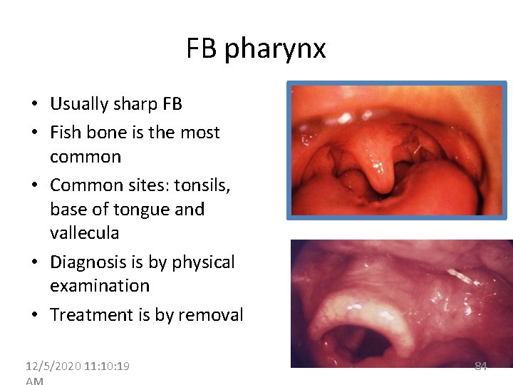 FB pharynx • Usually sharp FB • Fish bone is the most common •