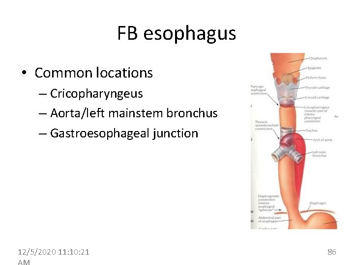 FB esophagus • Common locations – Cricopharyngeus – Aorta/left mainstem bronchus – Gastroesophageal junction