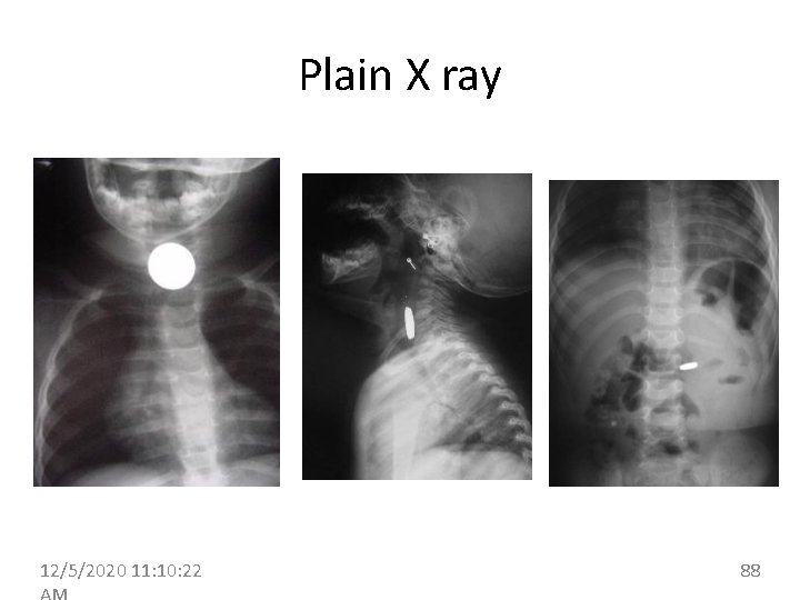 Plain X ray 12/5/2020 11: 10: 22 88 