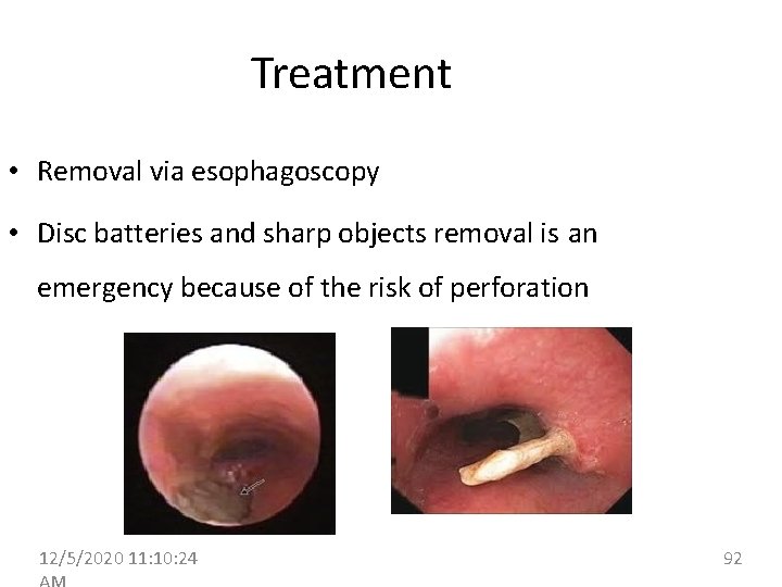 Treatment • Removal via esophagoscopy • Disc batteries and sharp objects removal is an