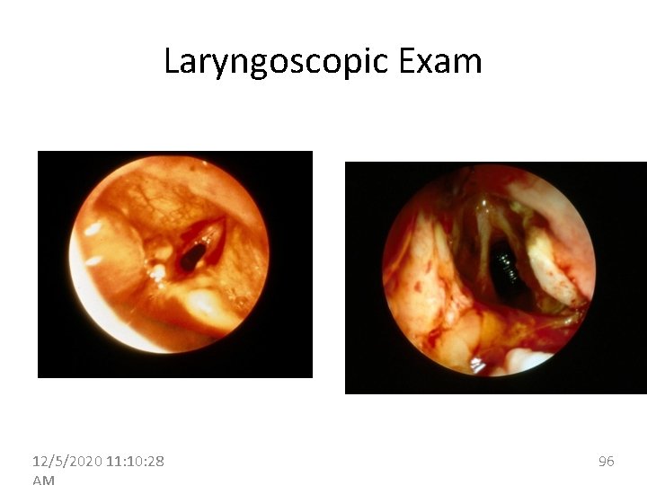 Laryngoscopic Exam 12/5/2020 11: 10: 28 96 