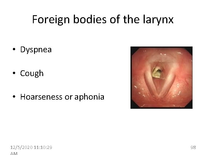 Foreign bodies of the larynx • Dyspnea • Cough • Hoarseness or aphonia 12/5/2020