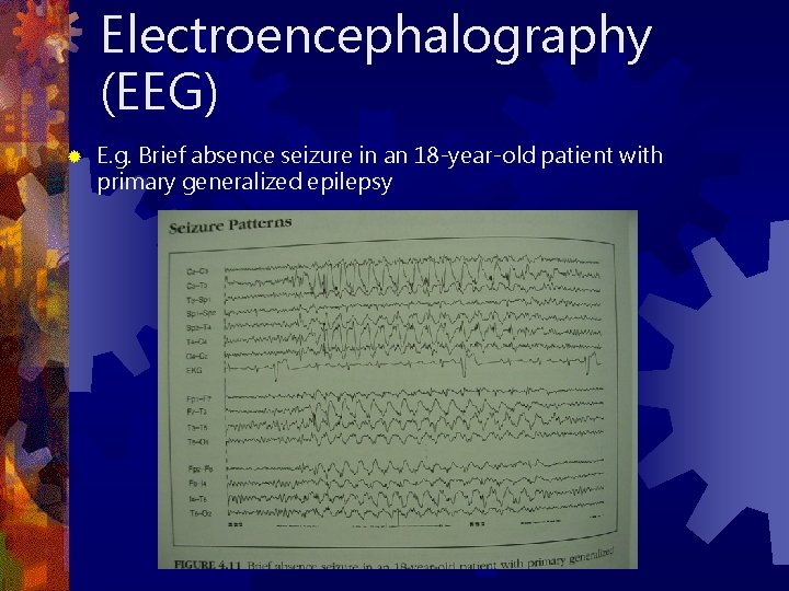 Electroencephalography (EEG) ® E. g. Brief absence seizure in an 18 -year-old patient with