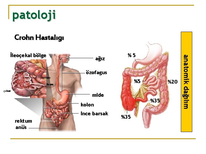 patoloji Crohn Hastalıgı ağız %5 özofagus İBH %5 ileum çekum mide %35 kolon İnce