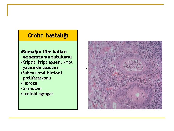 Crohn hastalığı • Barsağın tüm katları ve serozanın tutulumu • Kriptit, kript apsesi, kript