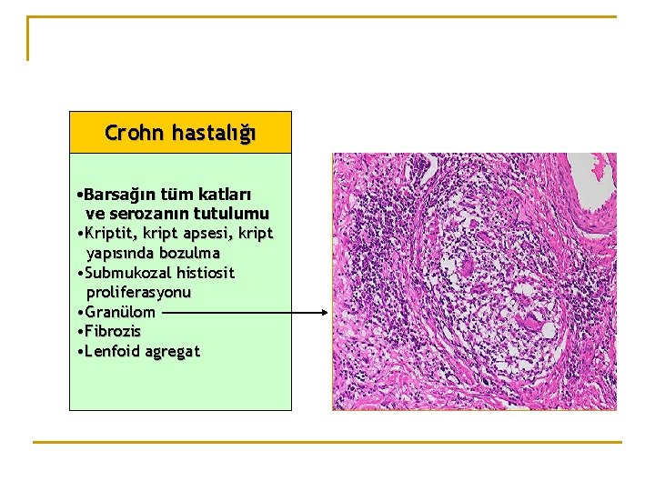 Crohn hastalığı • Barsağın tüm katları ve serozanın tutulumu • Kriptit, kript apsesi, kript