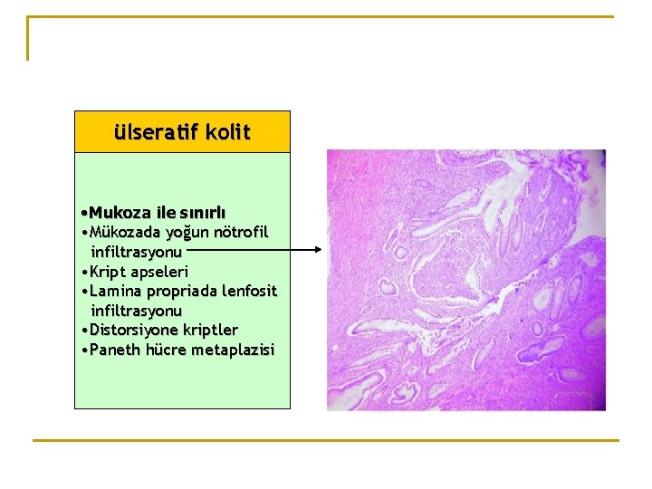 ülseratif kolit • Mukoza ile sınırlı • Mükozada yoğun nötrofil infiltrasyonu • Kript apseleri