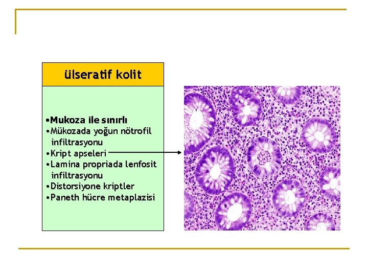 ülseratif kolit • Mukoza ile sınırlı • Mükozada yoğun nötrofil infiltrasyonu • Kript apseleri