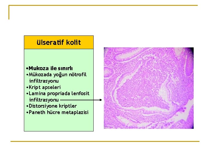 ülseratif kolit • Mukoza ile sınırlı • Mükozada yoğun nötrofil infiltrasyonu • Kript apseleri