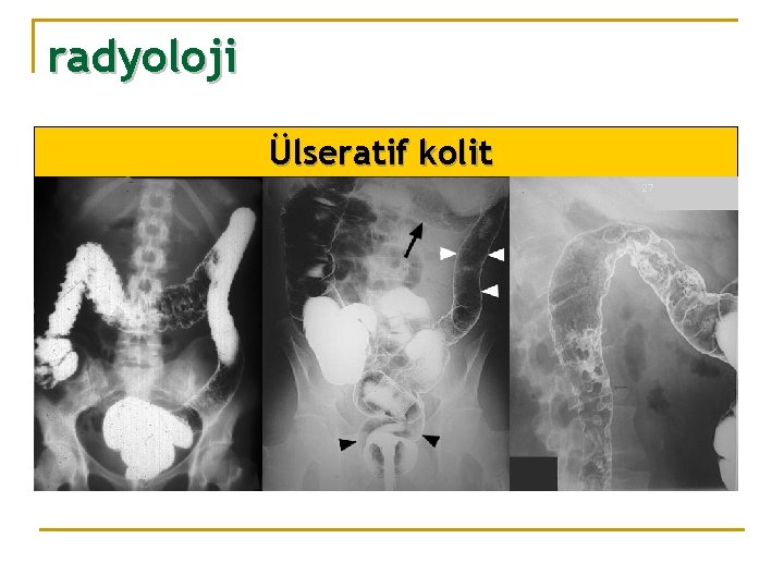 radyoloji Ülseratif kolit 