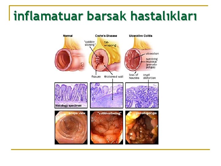 inflamatuar barsak hastalıkları 